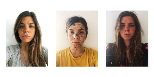 After I was bitten by one of those strange mosquitoes in Montenegro. Documentation of different stages of my bites After I was bitten by one of those strange mosquitoes in Montenegro. Documentation of different stages of my bites